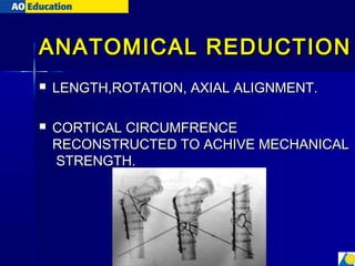 principles of fracture treatment | PPT