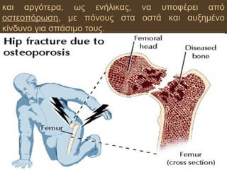 και αργότερα, ως ενήλικας, να υποφέρει από
οστεοπόρωση, με πόνους στα οστά και αυξημένο
κίνδυνο για σπάσιμο τους.
 