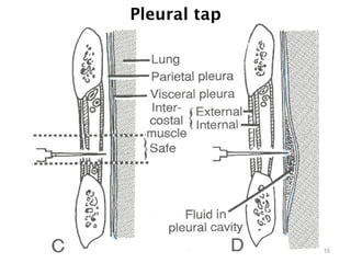 Pleural tap
15
 
