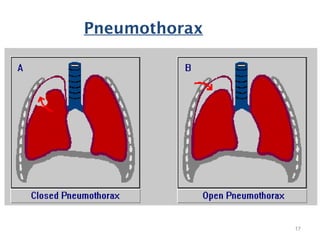 Pneumothorax
17
 