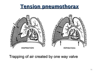 Tension pneumothoraxTension pneumothorax
Trapping of air created by one way valveTrapping of air created by one way valve
19
 
