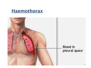 LARGE HAEMOTHORAX
Haemothorax
21
 
