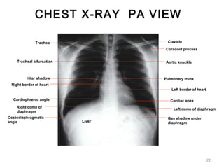 Liver
Trachea
Tracheal bifurcation
Hilar shadow
Right border of heart
Cardiophrenic angle
Right dome of
diaphragm
Costodiaphragmatic
angle
Clavicle
Aortic knuckle
Pulmonary trunk
Left border of heart
Cardiac apex
Left dome of diaphragm
Gas shadow under
diaphragm
Coracoid process
CHEST X-RAY PA VIEW
22
 
