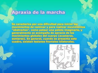 Se caracteriza por una dificultad para iniciar los
movimientos de caminar y para realizar movimientos
"abstractos", como patear una pelota imaginaria, y
generalmente se acompaña de apraxia de los
movimientos globales del cuerpo (acostarse,
sentarse). En general, cuando se presenta este
cuadro, existen lesiones frontales bilaterales.
 