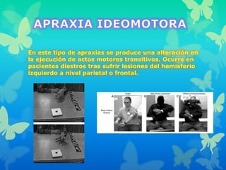 En este tipo de apraxias se produce una alteración en
la ejecución de actos motores transitivos. Ocurre en
pacientes diestros tras sufrir lesiones del hemisferio
izquierdo a nivel parietal o frontal.
 