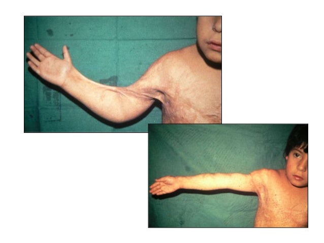 Resultado de imagen para cicatriz retráctil o deformante