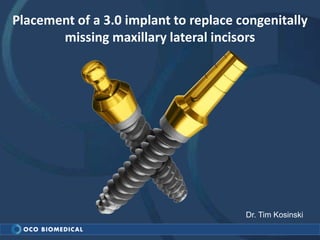 Placement of a 3.0 implant to replace congenitally
missing maxillary lateral incisors
Dr. Tim Kosinski