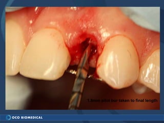 1.8mm pilot bur taken to final length