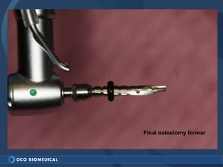 Final osteotomy former