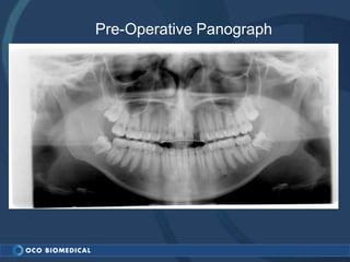 Pre-Operative Panograph