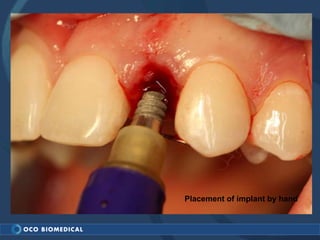 Placement of implant by hand