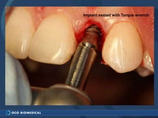 Implant seated with Torque wrench