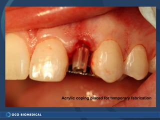 Acrylic coping placed for temporary fabrication