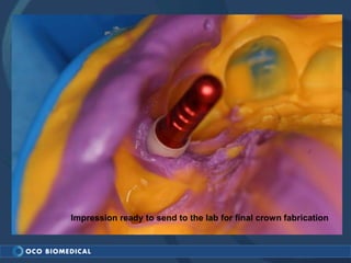 Impression ready to send to the lab for final crown fabrication