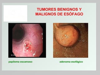 TUMORES BENIGNOS Y
MALIGNOS DE ESÓFAGO

papiloma escamoso

adenoma esofágico

 