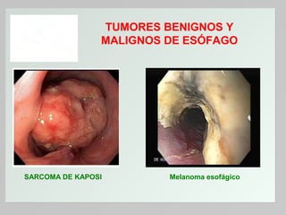 TUMORES BENIGNOS Y
MALIGNOS DE ESÓFAGO

SARCOMA DE KAPOSI

Melanoma esofágico

 