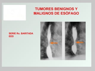 TUMORES BENIGNOS Y
MALIGNOS DE ESÓFAGO

SERIE Rx. BARITADA
EED

 