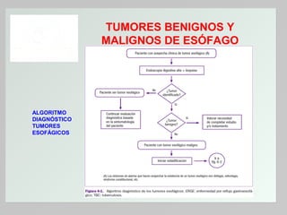 TUMORES BENIGNOS Y
MALIGNOS DE ESÓFAGO

ALGORITMO
DIAGNÓSTICO
TUMORES
ESOFÁGICOS

 