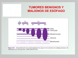 TUMORES BENIGNOS Y
MALIGNOS DE ESÓFAGO

 