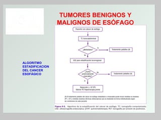 TUMORES BENIGNOS Y
MALIGNOS DE ESÓFAGO

ALGORITMO
ESTADIFICACION
DEL CANCER
ESOFÁGICO

 