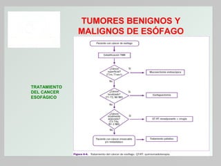 TUMORES BENIGNOS Y
MALIGNOS DE ESÓFAGO

TRATAMIENTO
DEL CANCER
ESOFÁGICO

 