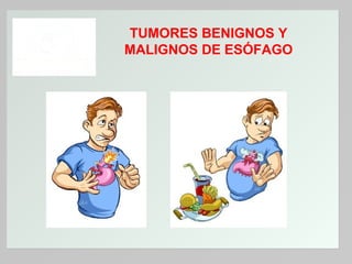 TUMORES BENIGNOS Y
MALIGNOS DE ESÓFAGO

 