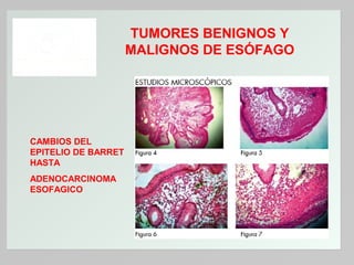 TUMORES BENIGNOS Y
MALIGNOS DE ESÓFAGO

CAMBIOS DEL
EPITELIO DE BARRET
HASTA
ADENOCARCINOMA
ESOFAGICO

 