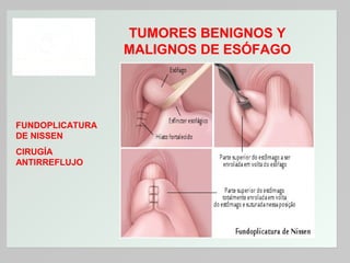TUMORES BENIGNOS Y
MALIGNOS DE ESÓFAGO

FUNDOPLICATURA
DE NISSEN
CIRUGÍA
ANTIRREFLUJO

 