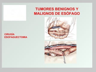 TUMORES BENIGNOS Y
MALIGNOS DE ESÓFAGO

CIRUGÍA
ESOFAGUECTOMIA

 