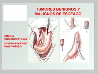 TUMORES BENIGNOS Y
MALIGNOS DE ESÓFAGO

CIRUGÍA
ESOFAGUECTOMIA
GASTRO-ESOFAGO
ANASTOMOSIS

 