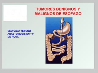 TUMORES BENIGNOS Y
MALIGNOS DE ESÓFAGO

ESOFAGO-YEYUNO
ANASTOMOSIS EN “Y”
DE ROUX

 