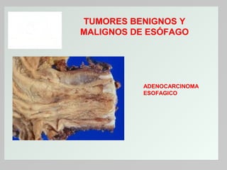 TUMORES BENIGNOS Y
MALIGNOS DE ESÓFAGO

ADENOCARCINOMA
ESOFAGICO

 