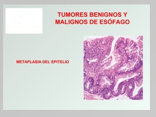 TUMORES BENIGNOS Y
MALIGNOS DE ESÓFAGO

METAPLASIA DEL EPITELIO

 