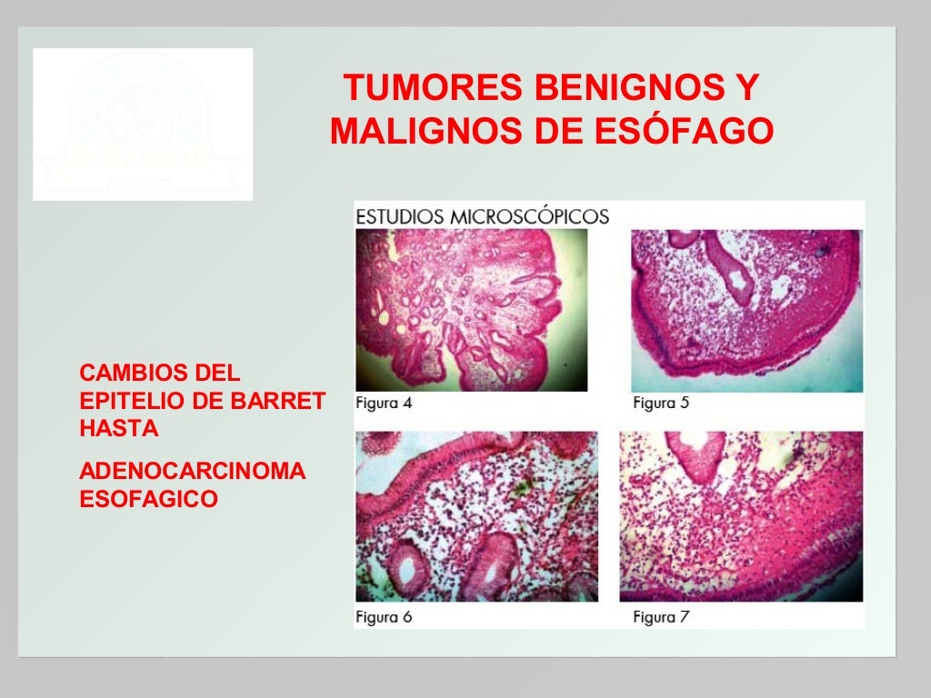 Diferença Entre Tumores Benignos E Malignos 3. tumores benignos y malignos esófago