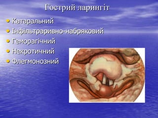 Гострий ларингіт
• Катаральний
• Інфільтраривно-набряковий
• Геморагічний
• Некротичний
• Флегмонозний

 