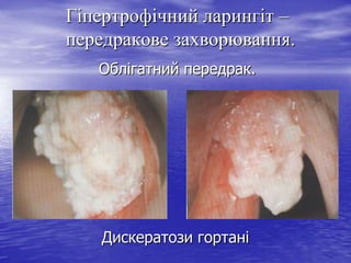 Гіпертрофічний ларингіт –
передракове захворювання.
Облігатний передрак.

Дискератози гортані

 