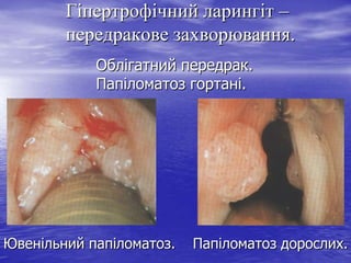 Гіпертрофічний ларингіт –
передракове захворювання.
Облігатний передрак.
Папіломатоз гортані.

Ювенільний папіломатоз.

Папіломатоз дорослих.

 