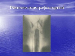 Рентгено-томографія гортані

 