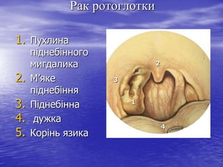 Рак ротоглотки
1. Пухлина
2.
3.
4.
5.

піднебінного
мигдалика
М’яке
піднебіння
Піднебінна
дужка
Корінь язика

2
3
1

4

 