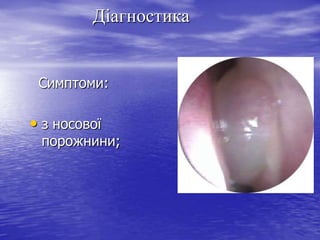 Діагностика

Симптоми:

• з носової

порожнини;

 