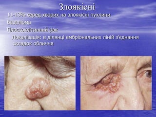 Злоякісні

11-13% серед хворих на злоякісні пухлини
Базаліома
Плоскоклітинний рак
Локалізація: в ділянці ембріональних ліній з’єднання
складок обличчя

 