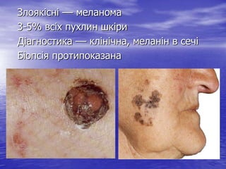 Злоякісні –– меланома
3-5% всіх пухлин шкіри
Діагностика –– клінічна, меланін в сечі
Біопсія протипоказана

 