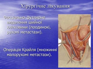 Хірургічне лікування
Фасціально-футлярне
видалення шийної
клітковини (поодинокі,
рухомі метастази).

Операція Крайля (множинні
малорухомі метастази).

 