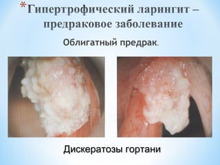 Облигатный предрак.

Дискератозы гортани

 