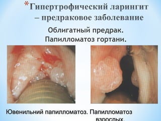 Облигатный предрак.
Папилломатоз гортани.

Ювенильний папилломатоз. Папилломатоз

 