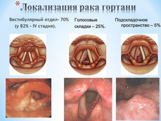 Вестибулярный отдел– 70%
(у 82% - ІV стадия).

Голосовые
складки – 25%.

Подскладочное
пространство – 5%.

 