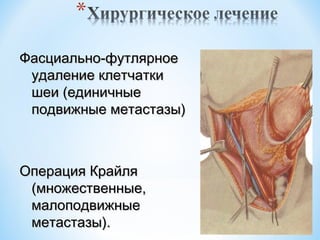 Фасциально-футлярное
удаление клетчатки
шеи (единичные
подвижные метастазы)

Операция Крайля
(множественные,
малоподвижные
метастазы).

 