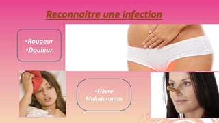 Reconnaitre une infection
•Rougeur
•Douleur

•Fièvre
Malodorantes

 
