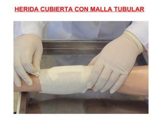 HERIDA CUBIERTA CON MALLA TUBULAR
 