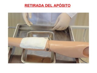 RETIRADA DEL APÓSITO
 